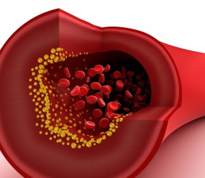 Closeup view of cholesterol plaque in blood vessel