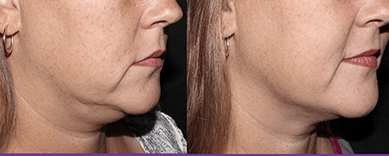 Before and after photo of trusculpt patient